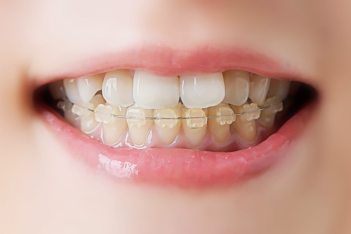 ハーフリンガル