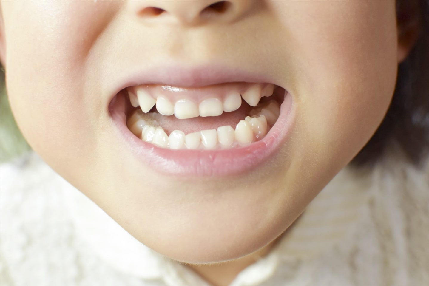 下顎前突（受け口）の子供